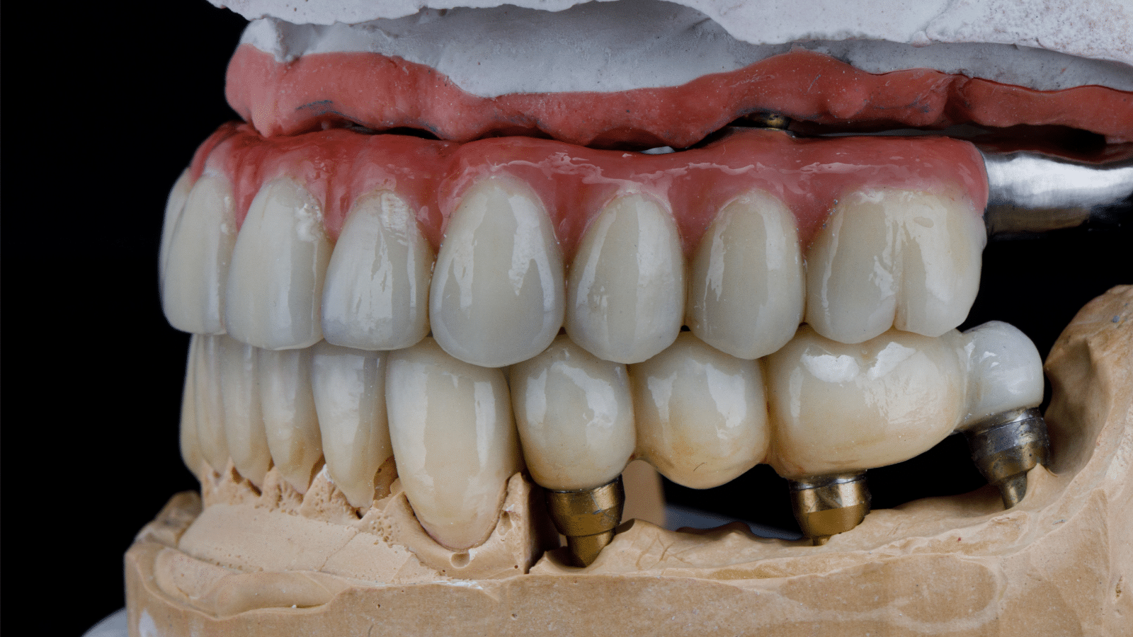Dental Implants Titanium vs Ceramic SOCO PERIO
