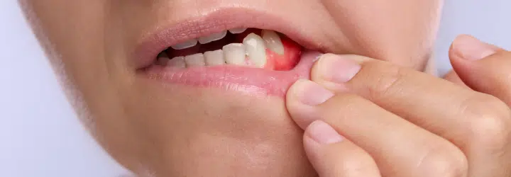 Gum Disease Stages, Symptoms, and Treatment
