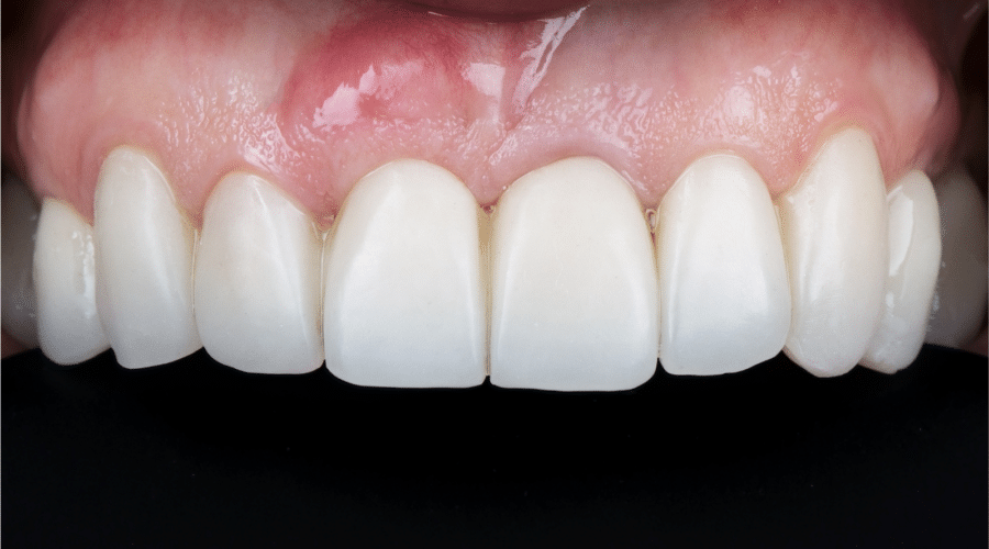 Healthy Gums and Implants