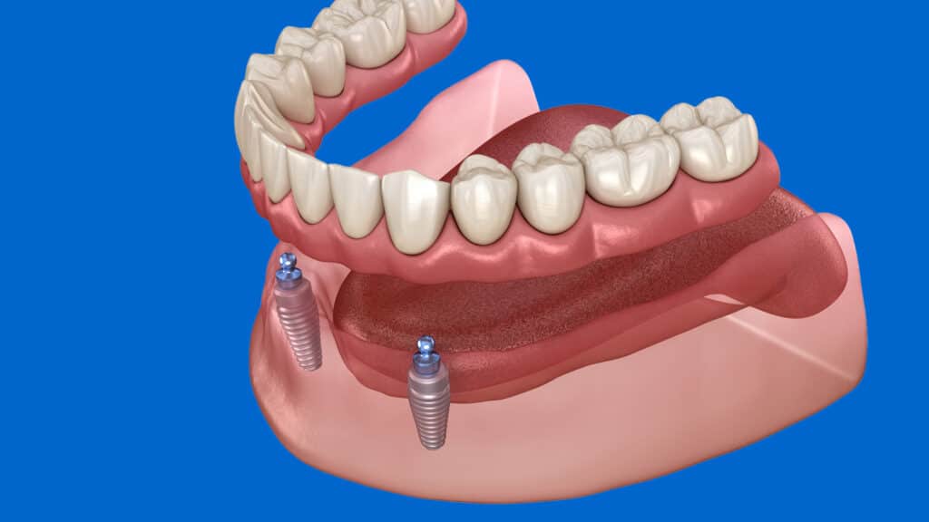 Denture implants illustration