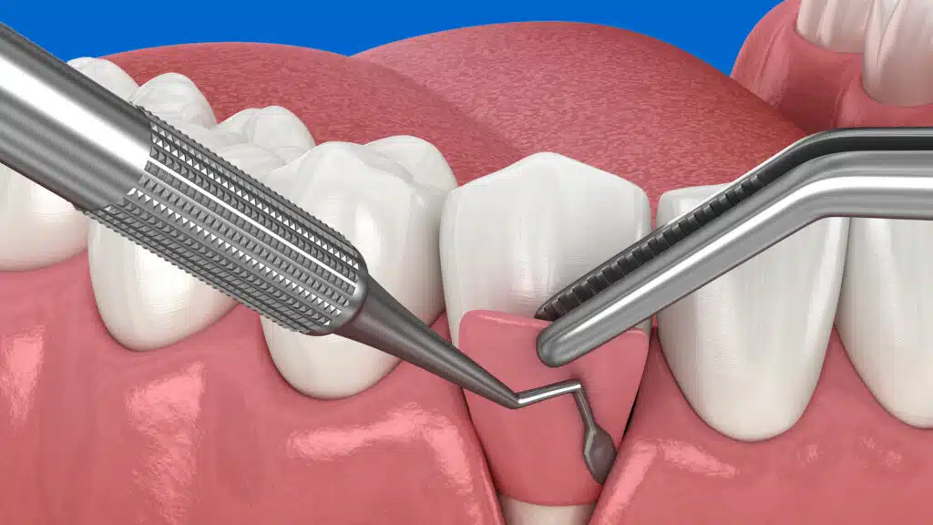 Gum graft illustration