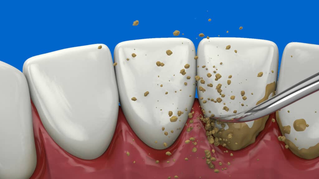 Illustration of Disadvantages and Advantages of Deep Cleaning Teeth