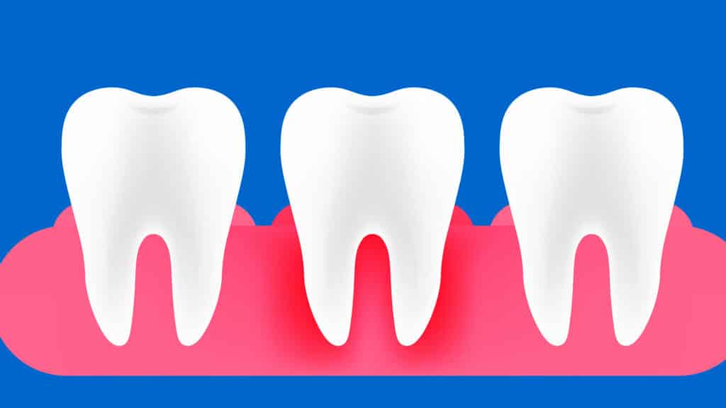 Gum Disease: Illustration of Why Are My Gums Bleeding?
