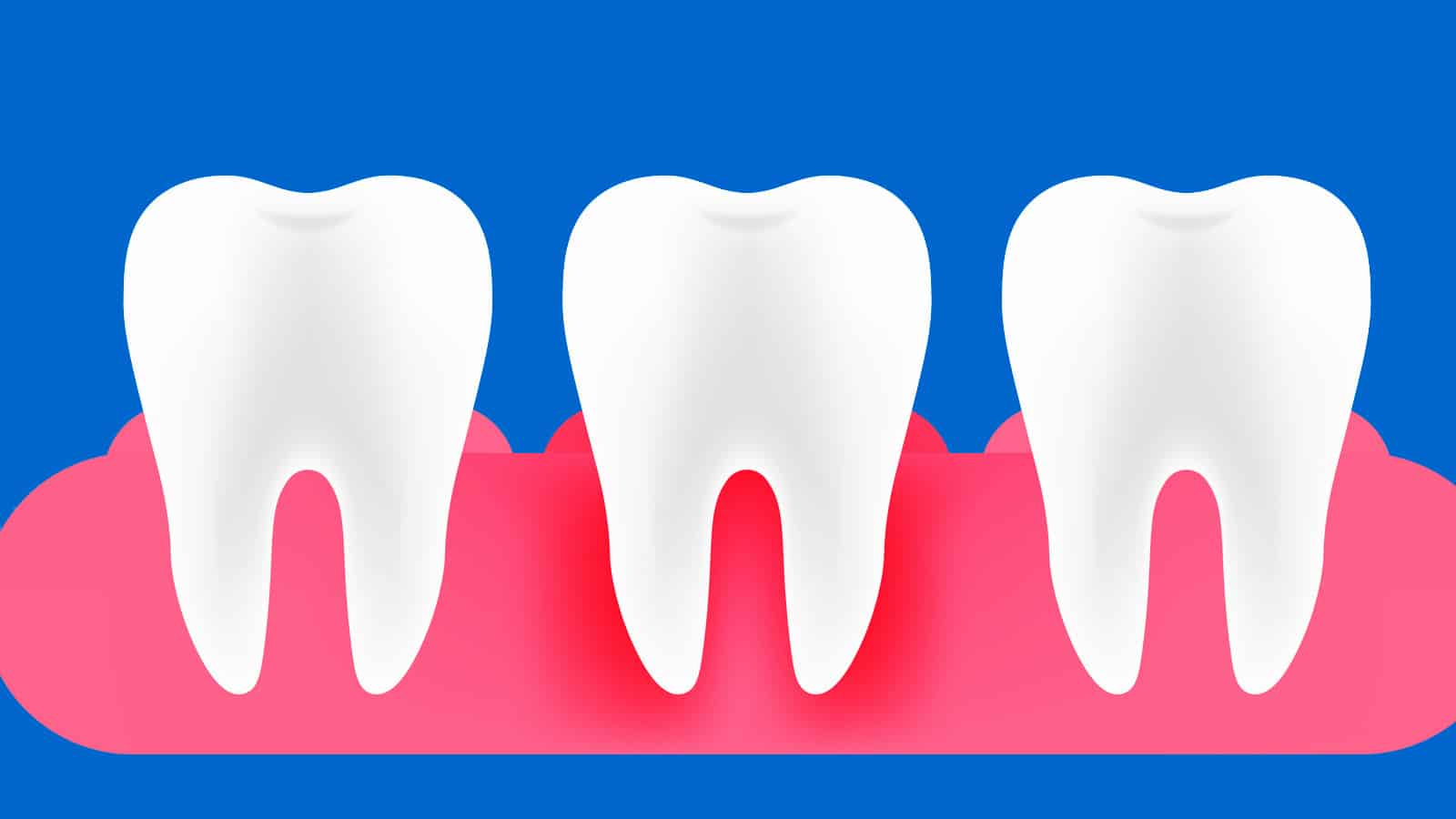 Gum Disease: Illustration of Why Are My Gums Bleeding?
